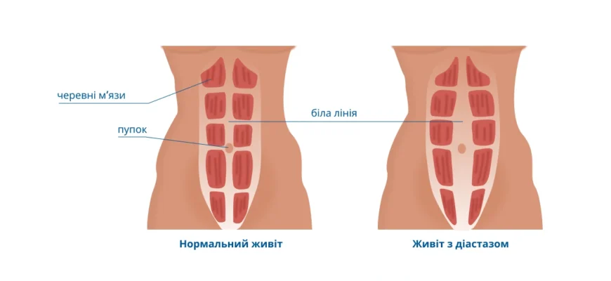 Діастаз після пологів: причини, симптоми і як відновити м’язи