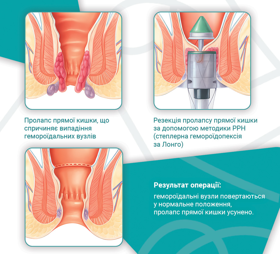 Лікування геморою за методом Лонго (степлерна гемороідопексія) в ...