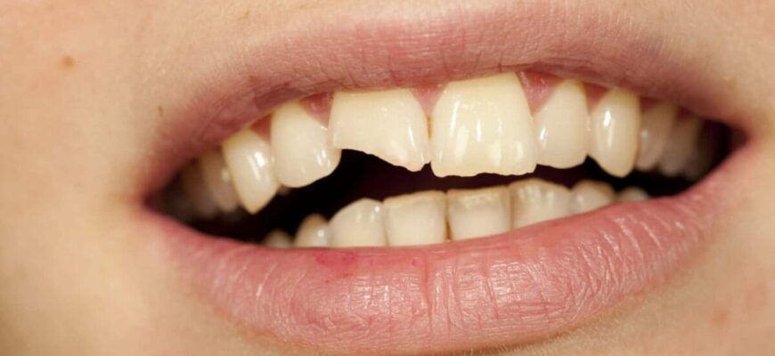 До чого сняться вставні зуби: значення та тлумачення сновидінь