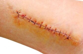 Догляд за раною після зняття швів: поради для швидкого загоєння