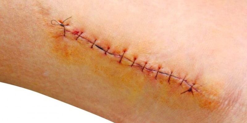 Догляд за раною після зняття швів: поради для швидкого загоєння