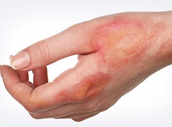 Лікування опіків в Кривому Розі – перша допомога та засоби від опіків