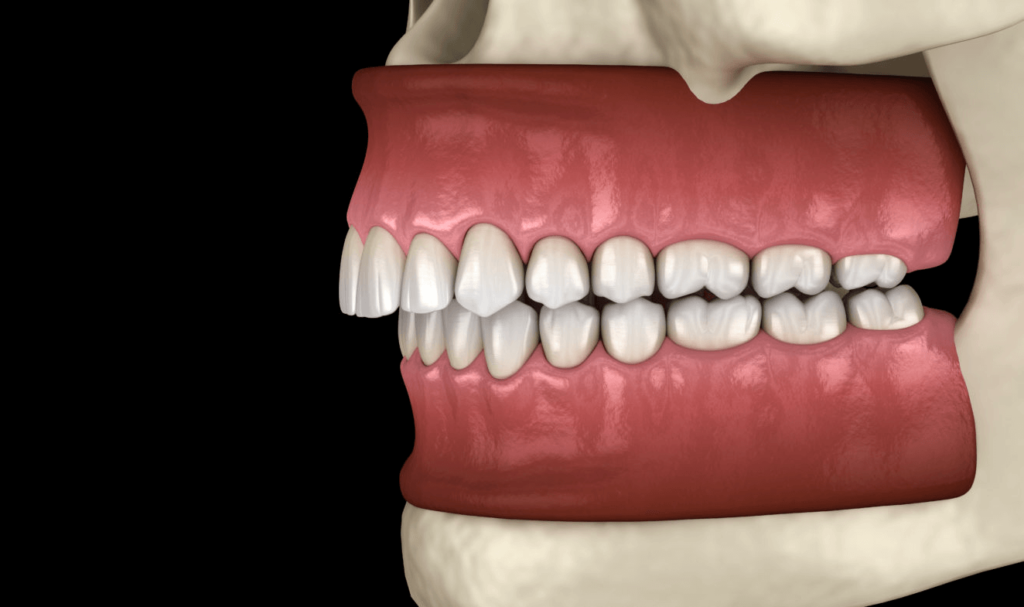 Флюс у дітей: що це, як лікувати та що робити якщо опухла щока у ...