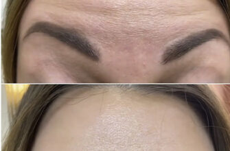 Ефекти ботоксу під очима: результати до і після процедури