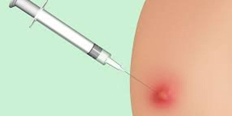 Ефективне лікування абсцесу після уколу: поради та рекомендації