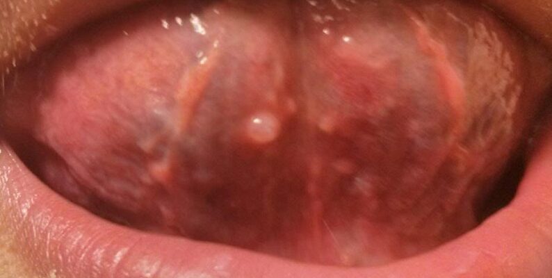 Ефективне лікування болючих прищів на язиці: поради та засоби