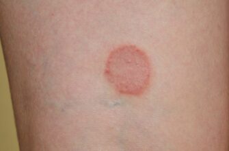 Ефективне лікування червоного плоского лишаю: кращі методи та поради