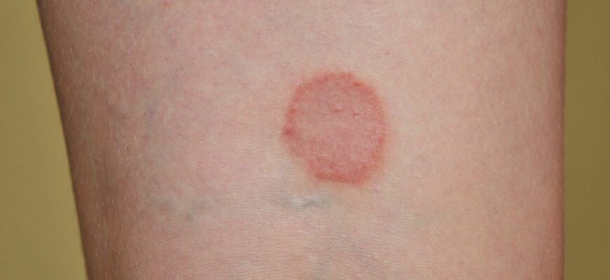 Ефективне лікування червоного плоского лишаю: кращі методи та поради