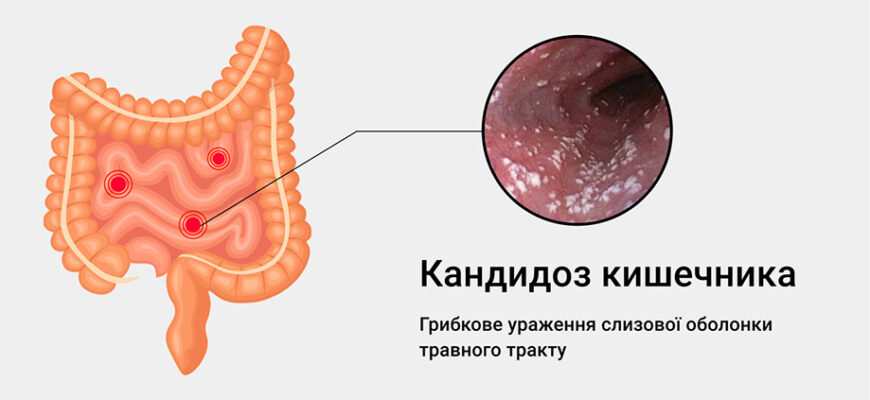 Ефективне лікування кандидозу кишечника: поради та засоби боротьби