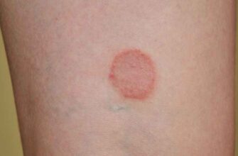 Ефективне лікування лишаю в домашніх умовах: перевірені методи