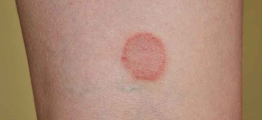 Ефективне лікування лишаю в домашніх умовах: перевірені методи