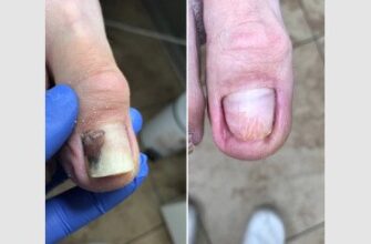 Ефективне лікування та догляд після видалення нігтя: поради лікарів