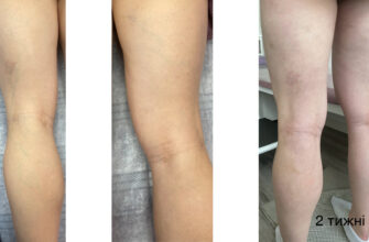Ефективне відновлення після ВЛК операції на варикозні вени: поради та рекомендації