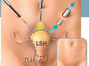 Ефективне відновлення після видалення міоми матки: рекомендації та поради