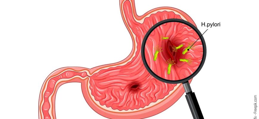 Ефективні ліки для боротьби з хелікобактер пілорі: як обрати найкраще?