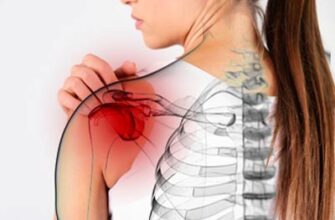 Ефективні ліки для лікування плечолопаткового періартриту: що обрати?