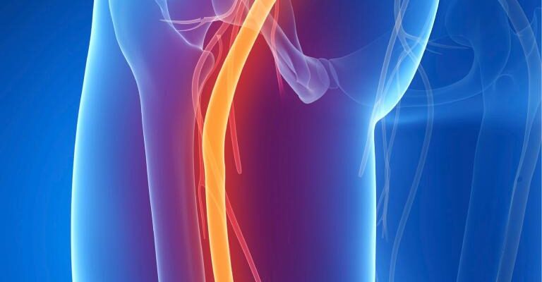 Ефективні ліки від болю при защемленні сідничного нерва: поради та огляд