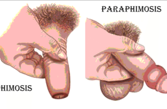 Ефективні ліки від фімозу: оберіть найкраще лікування для дорослих