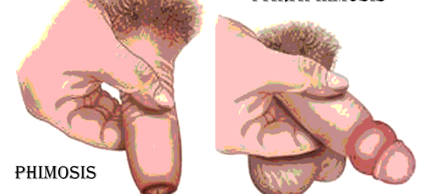 Ефективні ліки від фімозу: оберіть найкраще лікування для дорослих