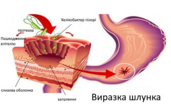 Ефективні ліки від Хелікобактер пілорі: огляд найкращих препаратів