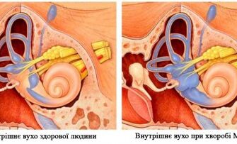 Ефективні ліки від хвороби Меньєра: сучасні методи лікування