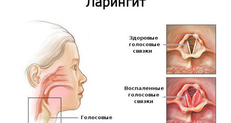 Ефективні ліки від ларингіту для дорослих: що обрати для лікування?