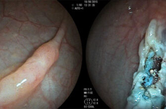 Ефективні методи боротьби із запором після колоноскопії: поради фахівців