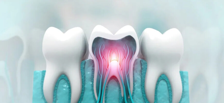 Ефективні методи для знечулення та вбивства нерва зуба в домашніх умовах
