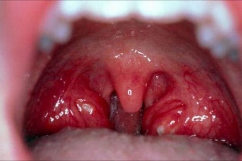 Чим полоскати горло при ангіні ᐉ Як лікувати ангіну - Amel Dental ...