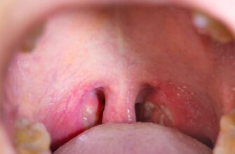 Ефективні методи лікування ангіни у дітей: найкращі поради батькам