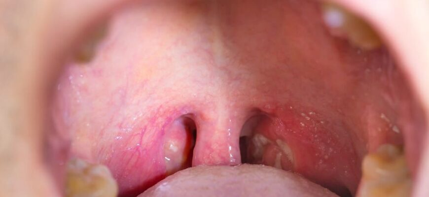 Ефективні методи лікування ангіни у дітей: найкращі поради батькам