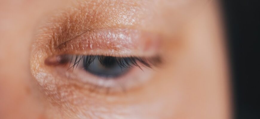 Ефективні методи лікування блефариту: поради та рекомендації лікарів