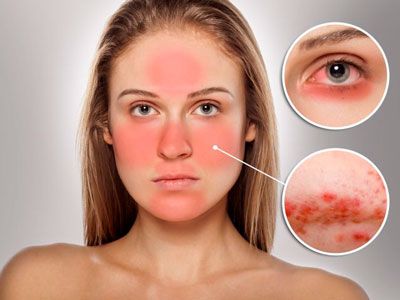 Ефективні методи лікування демодекозу: як позбутися паразитів