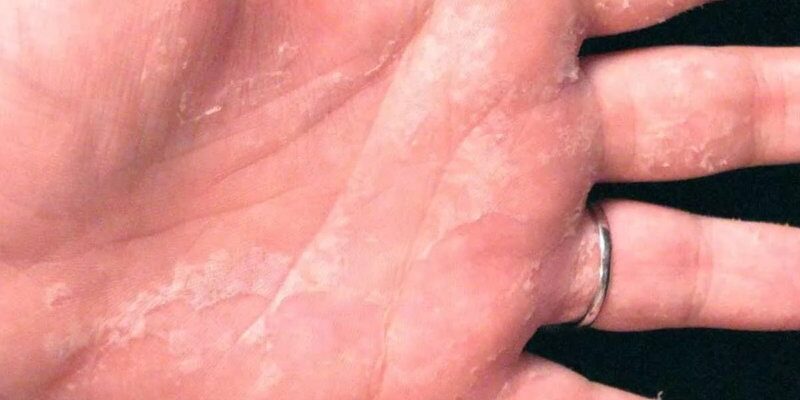 Ефективні методи лікування дисгідрозу: рекомендації та поради лікарів Ефективні методи лікування дисгідрозу: рекомендації та поради лікарів