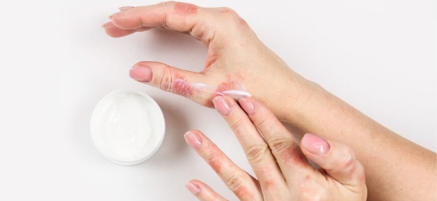 Ефективні методи лікування екземи на руках: найкращі засоби та поради
