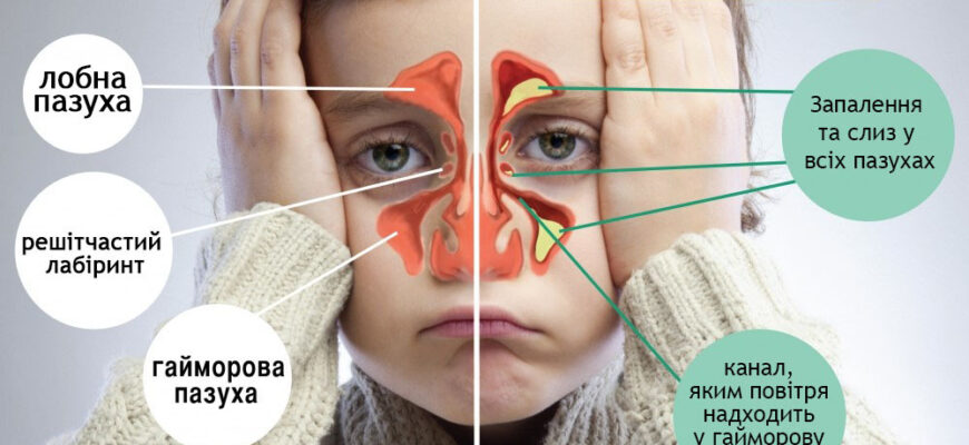 Ефективні методи лікування гаймориту в домашніх умовах: поради та засоби