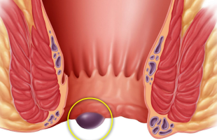 Ефективні методи лікування геморою після пологів: поради та рекомендації