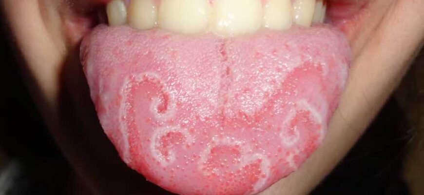 Ефективні методи лікування географічного язика: поради та рекомендації