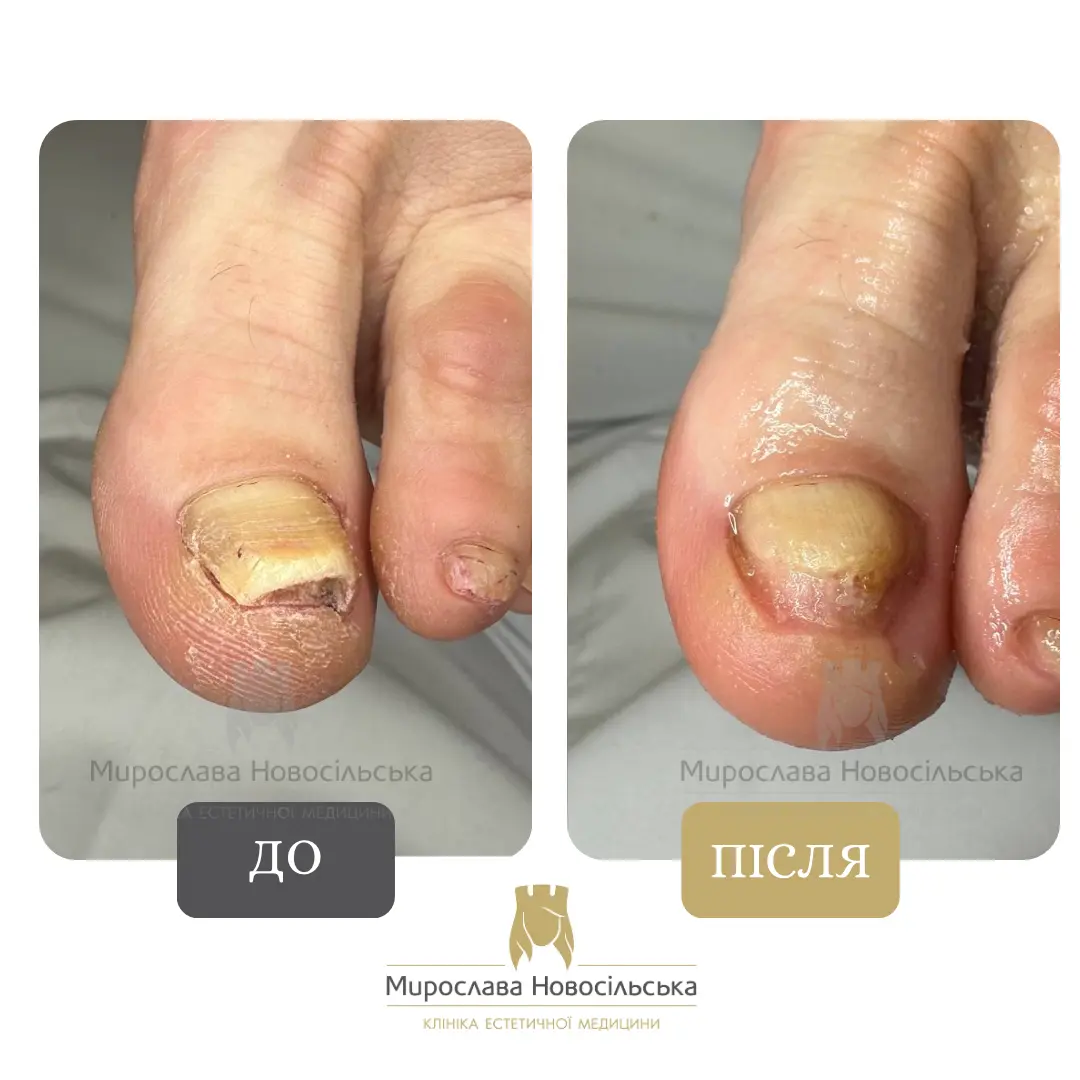 Ефективне лазерне лікування грибка нігтя | Ціна, відгуки, запис у ...