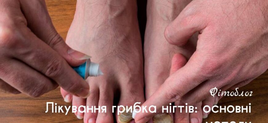 Ефективні методи лікування грибка нігтів на руках: сучасні поради
