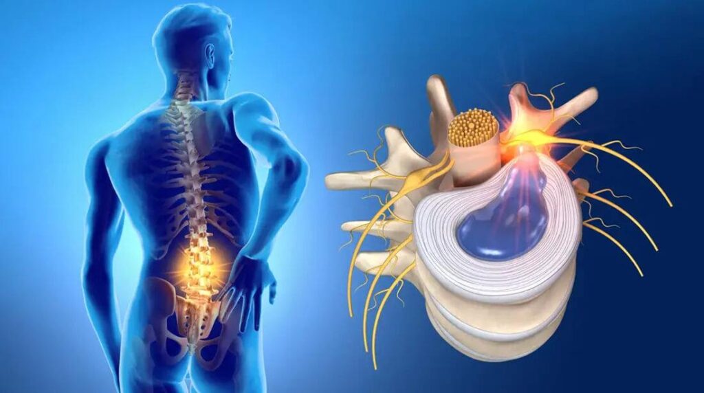 Ефективні консервативні методи лікування міжхребцевих гриж ...