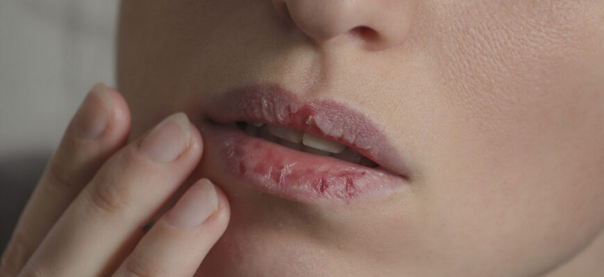 Ефективні методи лікування хейліту: як позбутися проблеми швидко