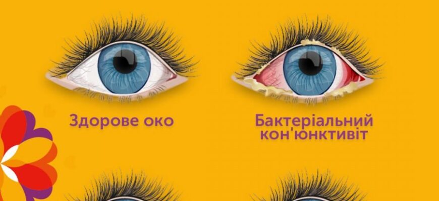 Ефективні методи лікування кон’юнктивіту: які засоби обрати?