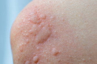 Ефективні методи лікування кропив’янки: що обрати для швидкого одужання?