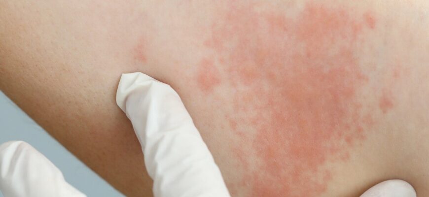 Ефективні методи лікування кропивниці: поради та засоби боротьби