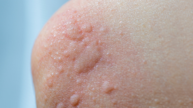 Лікування кропив'янки народними засобами, МЦ Альтернатива