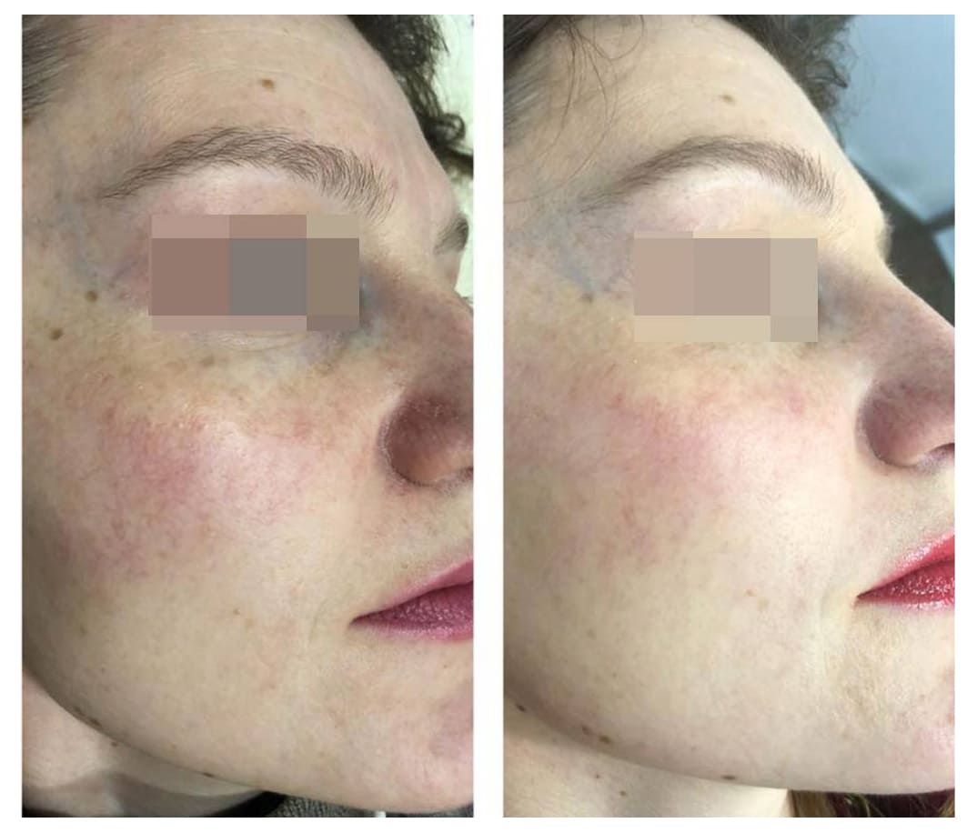 Лікування купероза (видалення судин) в Сарнах — 1 косметолог, 1 ...