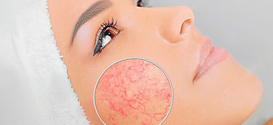 Ефективні методи лікування куперозу на обличчі: огляд засобів і процедур