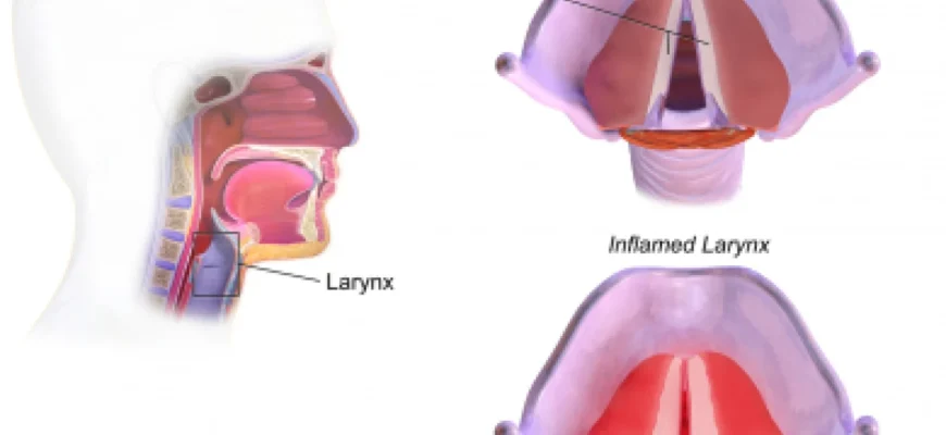 Ефективні методи лікування ларингіту: поради та рекомендації