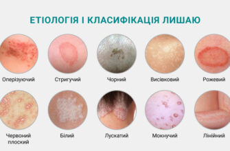 Ефективні методи лікування лишаю: поради та рекомендації лікарів